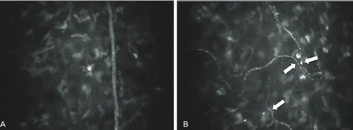 Figure 2. Corneal subbasal nerve plexus images of normal eye (A) and penetrating keratoplasty eye (B) digitalized  directly from confocal microscopy through focusing scan (case 1)