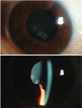 Figure  1. Slitlamp  photograph  shows  0.4×0.4  cm-  sized  mass  behind  inferior  iris.