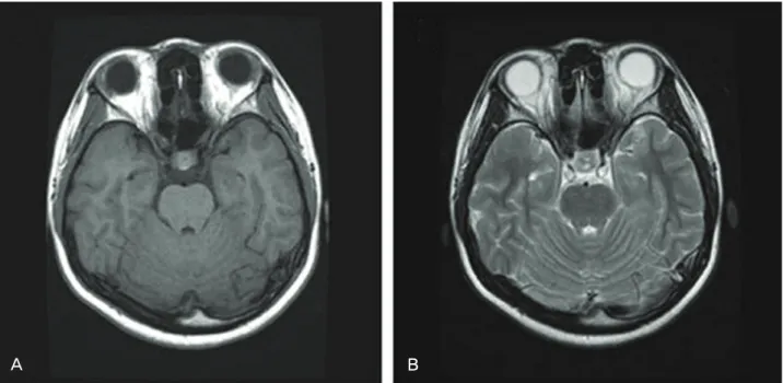 Figure  2. (A),  (B)  T1  and  T2  weighted  magnetic  resonance  imaging  scans  did  not  show  any  abnormal  signal  intensity  in  the  midbrain.