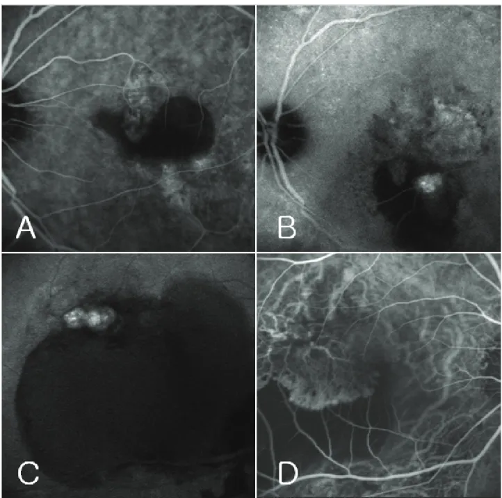 Figure  1. Indocyanine  green  angiography  (ICGA)  of  case  11  (A,  B)  and  case  13  (C,  D)  at  the  initial  visit  (A,  C)  and before combined treatment of intravitreal bevacizumab injection and photodynamic therapy (PDT) (B, D)