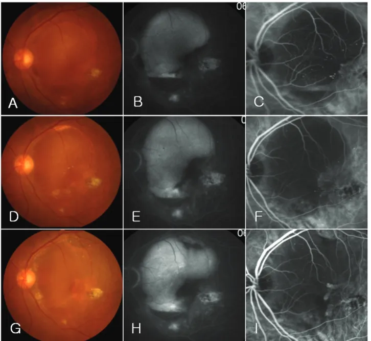 Figure 4. Fundus photographs, fluorescein angiography (FA) and indocyanine green angiography (ICGA) of case 6  at  baseline  (A-C),  at  3  months  after  first  combined  treatment  (D-F)  and  at  3  months  after  second  combined  treatment and one add