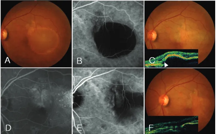 Figure 5. Fundus photographs, fluorescein angiography (FA), optical coherence tomography (OCT) and indocyanine  green  angiography  (ICGA)  of  case  8
