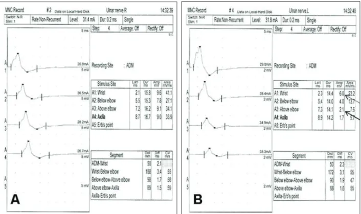 Figure 2. Neurophysiologic test of the right (A) and left (B) ulnar nerve. The evoked muscle action potential in the  left ulnar nerve with stimulation proximal to the elbow (solid arrow) was less than 50% of the potential obtained with  stimulation of the