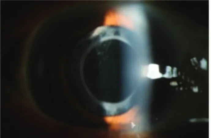 Figure 2. Preoperative orbit CT finding: tumorous lesion at inferolateral aspect of the iris or ciliary body in the right  eyeball.