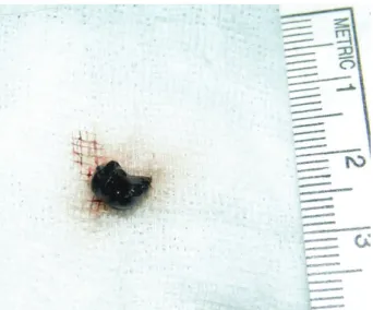 Figure  4. Gross  finding  of  excised  tumor  mass,  which  is dark brown, soft, and smooth surfaced and 0.5×0.5 