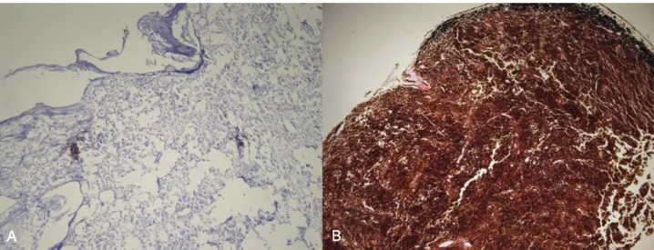 Figure 5. Microscopic appearance of melanocytoma of the ciliary body (A) (Histopathologic examination, ×40)  tumor cells are polygonal melanocytes with small vesicular nuclei and abundant cytoplasm totally packed with  melanin  granules  (B)  tumor  cells 