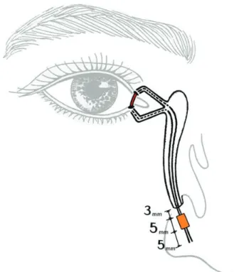 Figure  1. Bicanalicular  silicone  tube  is  in  place  and  silicone sponge is placed 2~3 mm below the inferior  meatus.