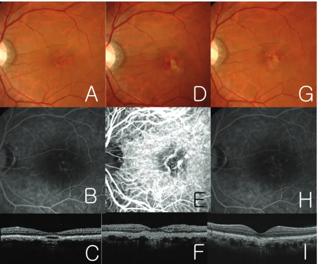 Figure 2. A 43-year-old male (patient 25 in table 1) with baseline visual acuity 1.0. A and C, Fundus  photography  and  OCT  showed  PED  at  the  juxtafoveal  area