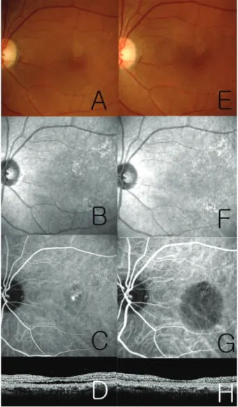 Figure 3. A 58-year-old female (patient 9 in table 1)  with  baseline  visual  acuity  0.15