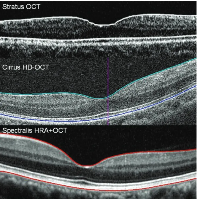 Figure  6. Tomographies  of  the  macula  taken  by  the  three  OCTs  with  reference  lines