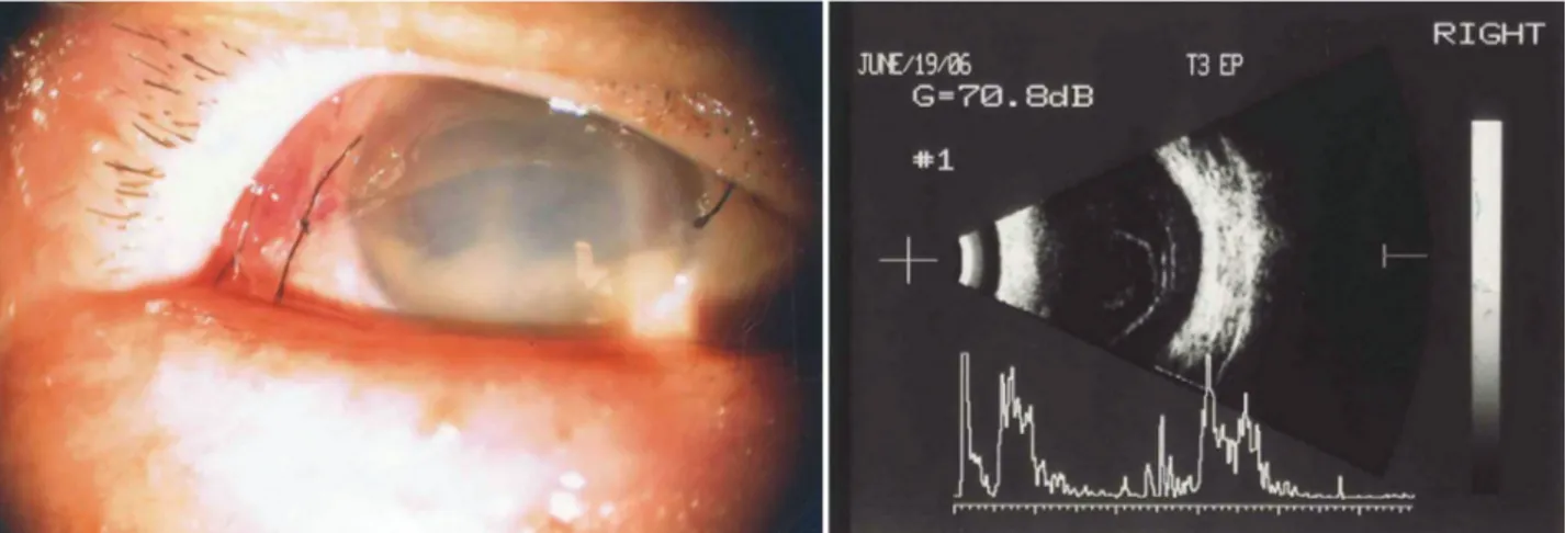 Figure  2. Slit  lamp  photograph  (left)  and  ultrasonogram  (right)  obtained  4  days  after  intravitreal  triamcinolone  acetonide  injection