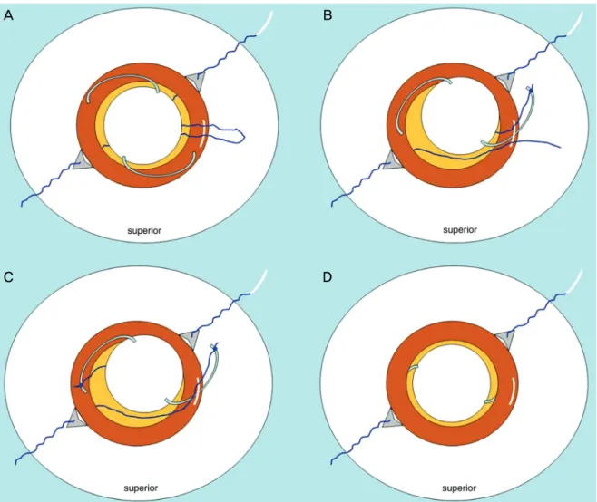Figure  1.  (A)  The  PC  IOL  is  placed  in  the  anterior  chamber  through  the  pupil  and  over  the  iris