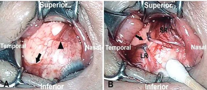 Figure 2. Intraoperative findings demonstrate (A) the path of the lateral rectus (arrow) muscle was dislocated into the  inferotemporal quadrant of the globe and the superior rectus muscle (arrow head) was dislocated into the superonasal  quadrant of the g