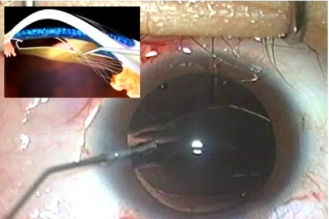 Figure 2. Attached zonules can be separated with intra- intra-ocular  scissors.