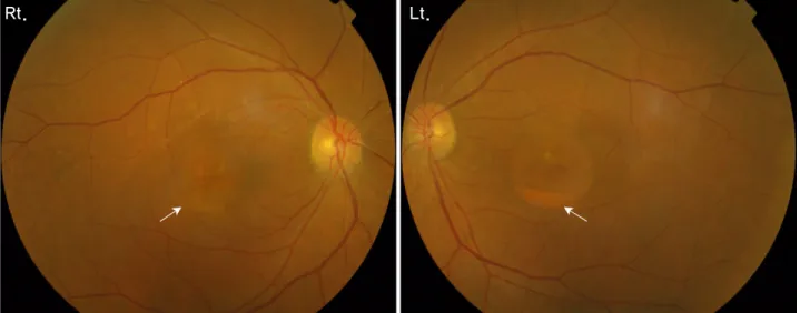 Figure  1. Fundus  findings  show  a  well-circumscribed,  circular  area  of  macula  elevation  in  both  eyes