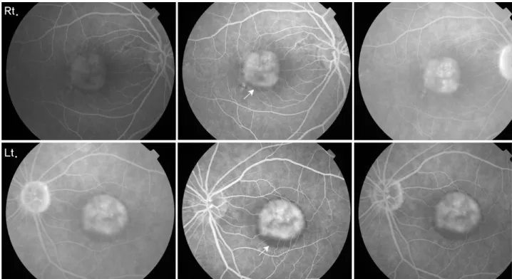 Figure 3. Fluorescein angiography findings of both eyes reveal well-defined hyperfluorescence in the early phase  and persistent hyperfluoresence in the late phase, corresponding to pigment epithelial detachment
