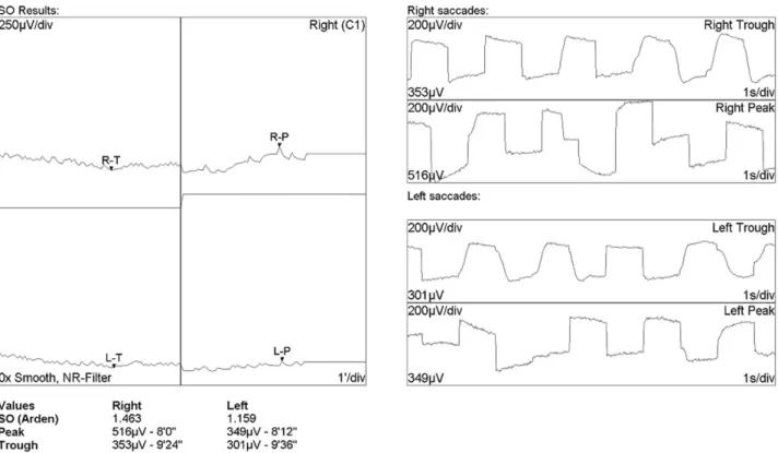 Figure  7. An  electro-oculogram  is  abnormal  with  an  Arden  ratio  of  1.463,  1.159  in  both  eyes,  respectively