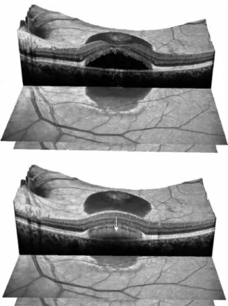 Figure  8. Spectral  domain  optical  coherence  tomo- tomo-graphy findings of the left eye at the last visit show  a  clearly  visible  retinal  pigment  epithelium  split  and  a  low  reflective  space  between  split  retinal  pigment  epithelium  laye