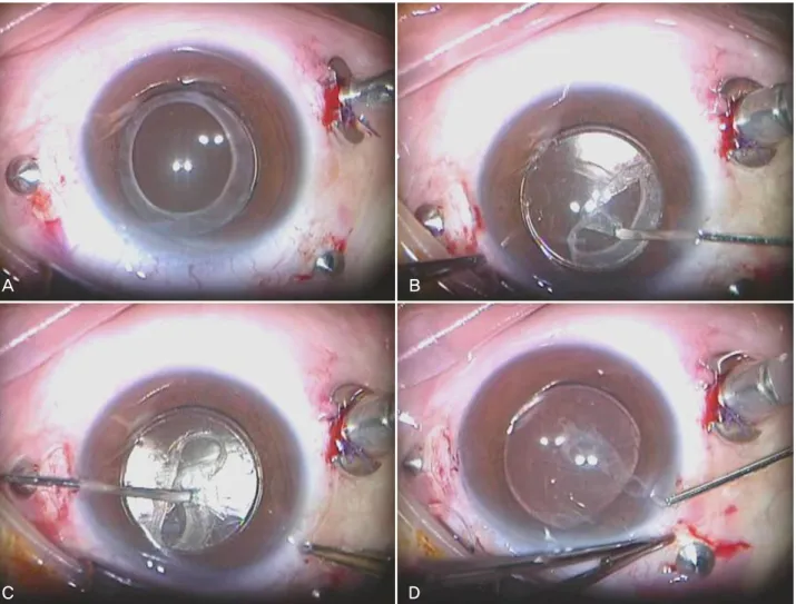 Figure 2. Surgical removal of anterior capsular opacity (ACO). (A) A broad ACO was seen preoperatively