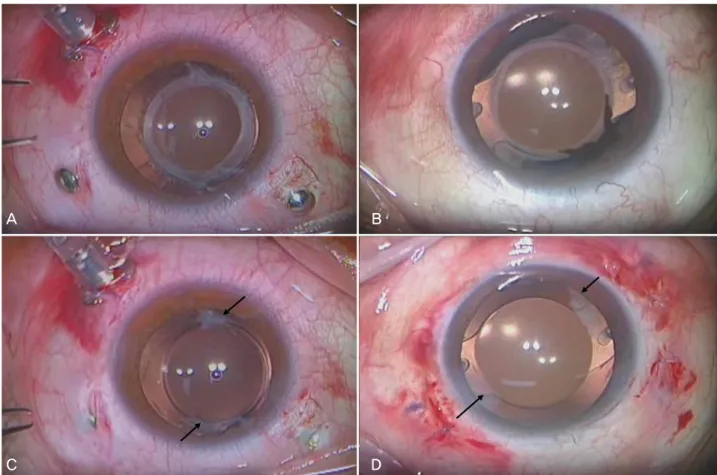 Figure  3.  Intraocular  lens  (IOL)  stability  depending  on  the  IOL  type.  Anterior  and  posterior  capsular  opacity  in  a  3  piece  open-loop  haptic  IOL  (A)  and  a  single  piece  closed-loop  haptic  IOL  (B)