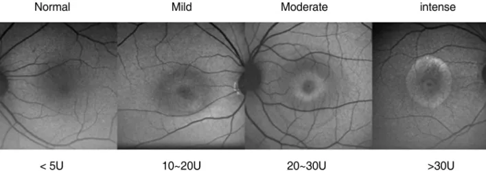 Figure  1.  Amount  of  fundus  autofluorescece  intensity  change  compared  to  background  intensity.
