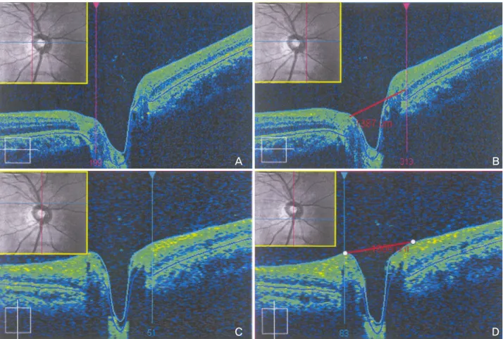 Figure  1. Setting  dimensions  of  the  optic  disc.  A  and  B,  Measurement  of  optic  disc  transverse  length  (red  line)