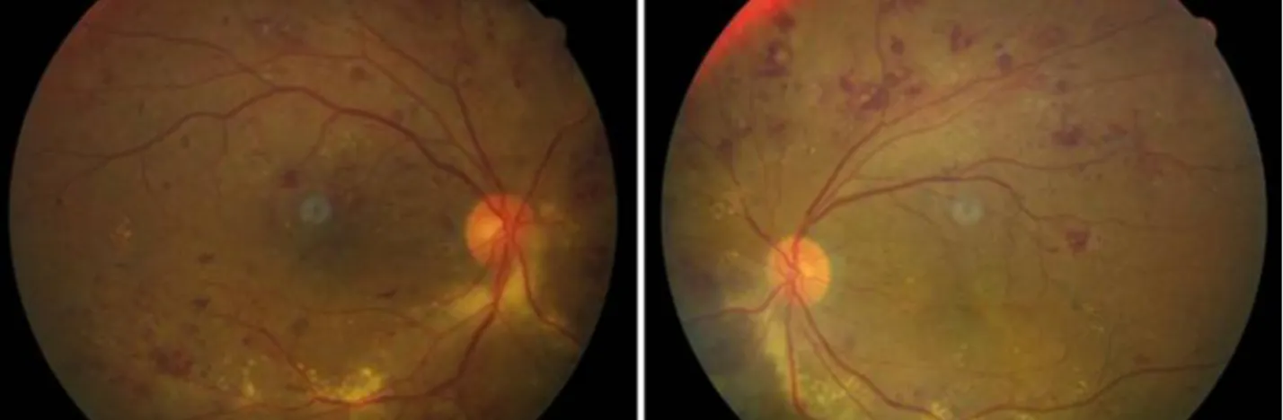 Figure 1. Fundus color photographs of the patient showed diffuse multiple dot and blot hemorrhages throughout the retina  of  both  eyes.