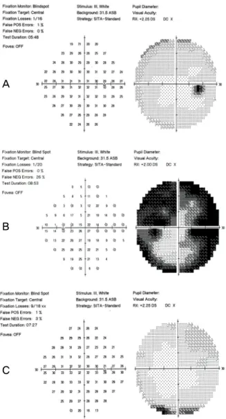Figure  3.  Humphrey  visual  field  test  of  the  right  eye  (A) preoperatively and the left (B) and the right eye  (C)  6  weeks  after  transsphenoidal  pituitary  adenoma  resection