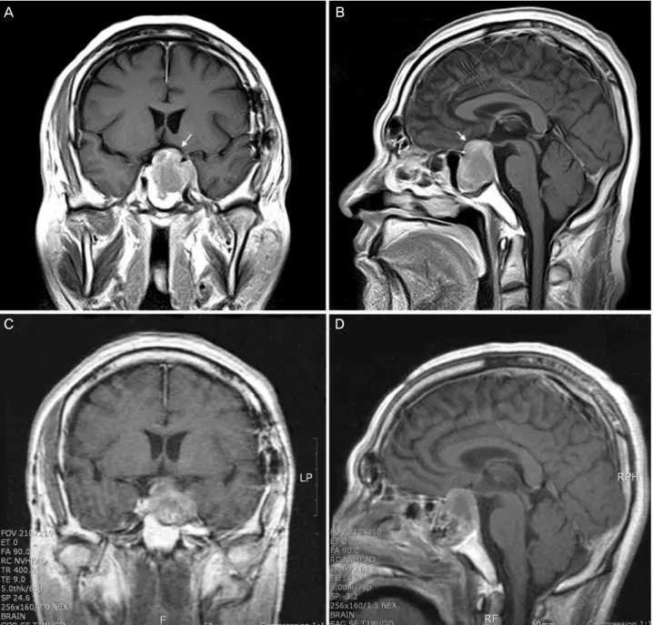 Figure 4. Preoperative coronal (A) and sagittal (B) enhanced T1-weighted MR image showed peripheral enhancing  sellar and suprasellar mass markedly compressing the optic chiasm (arrow)