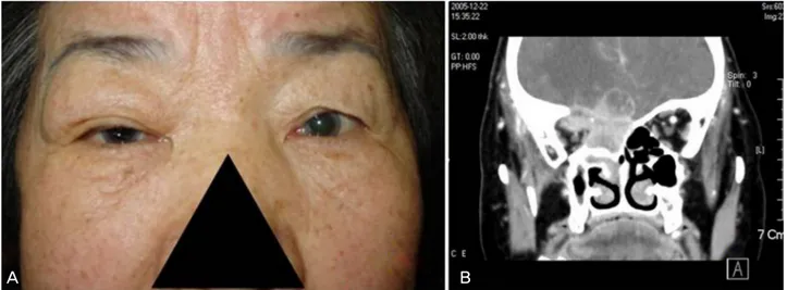 Figure 3. (A) She first visited the ophthalmic clinic with mild Rt. exophthalmos. The diagnosis was delayed for  4 month due to nonspecific ocular pain 
