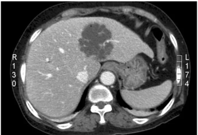 Figure 2. Abdominal CT finding of patient 2. Low attenuated, 6 cm-sized mass was found at the left lobe of the liver, consistent  with  liver  abscess.