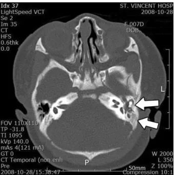 Figure  2. Temporal  bone  CT  scan  demonstrating  left  otitis media (upper arrow) and mastoiditis (lower arrow).
