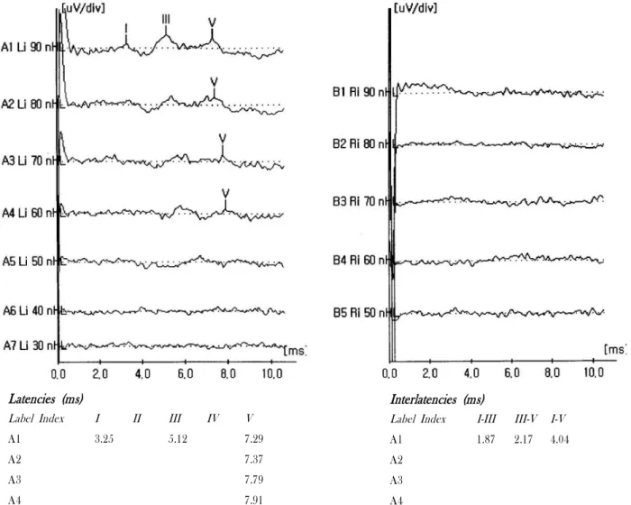 Figure 3. Auditory brain stem response showing absence of the right electropotential (left), which indicates right  cochlear  nerve  palsy.