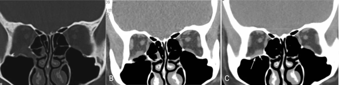 Figure 4. Computerized tomography (CT) of patient who were followed up to postoperative 24 months