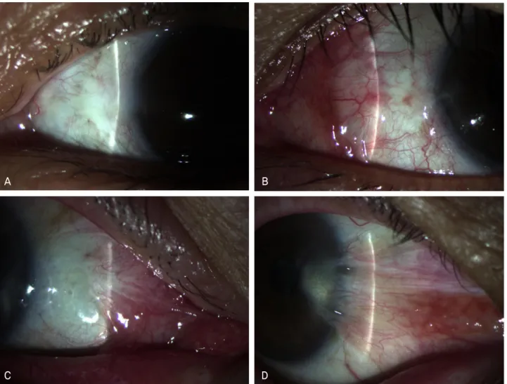 Figure 2. Grading of recurrence after pterygium surgery. (A) Grade 0, normal appearance of the operated site