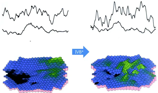 Figure 1. Changes in plot of mfERG after intravitreal bevacizumab injection; implicit time was shortened and retinal  response  densities  were  increased  on  ring  1  and  2  areas  of  mfERG  after  IVB  injection
