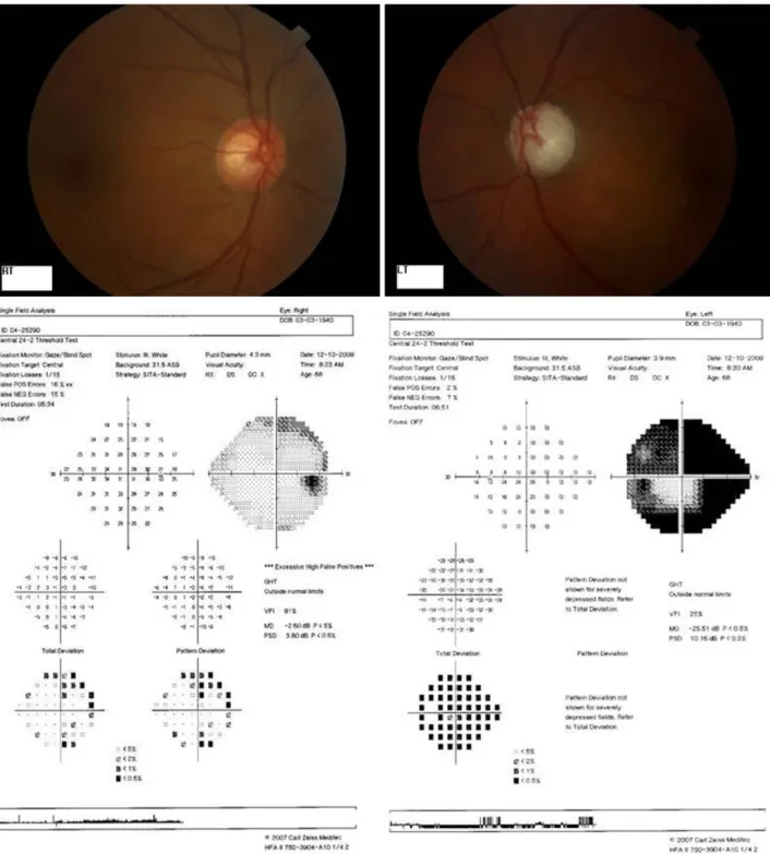 Figure  1. Visual  field  test  shows  the  central  island  corresponding  to  disc  photograph  in  the  left  eye