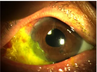Figure  2. Slit  lamp  photograph  shows  that  exposed  nec-  rotizing  sclera  is  well  covered  by  amnion  membrane  at  1  week  after  surgery.