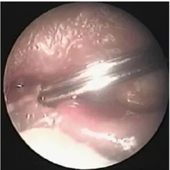 Figure 1. The photograph of putting two probes in the left  lower canaliculus.