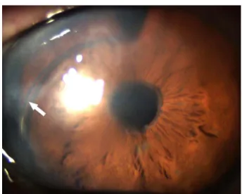 Figure 1. Each line represents the changes in best corrected  visual acuity for a single  patient.