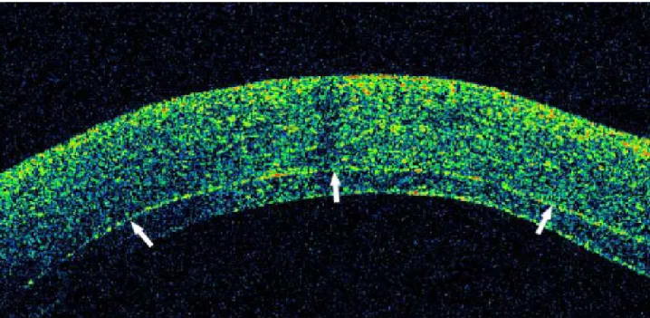 Figure 4. OCT shows smooth interface and regular thickness of the corneal graft  (arrows).