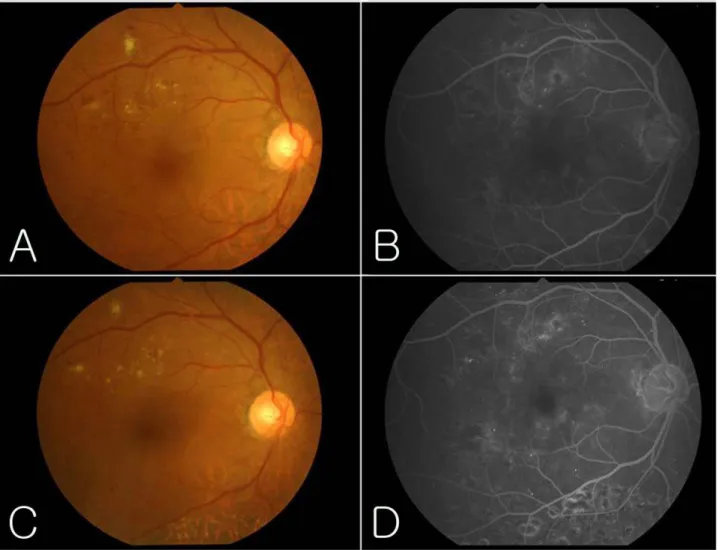 Table 3. Mean visual acuity and IOP during in both  groups without CSME