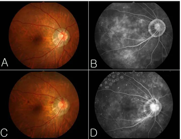 Table 4. Mean visual acuity and IOP during study  peroid in both  groups with CSME