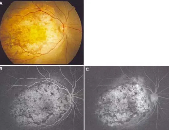 Figure 1. (A) Fundus photograph of the right eye shows large, well-demarcated, round, yellow-white lesion involving the  peripapillary area and macula