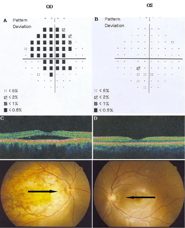 Figure 3. (A) The visual field of the right eye shows a defect relatively small compared to lesion size