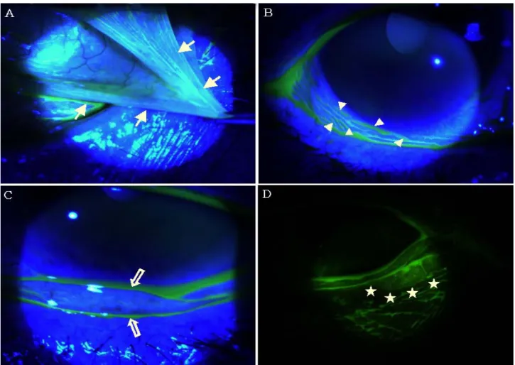Figure 3. Objective signs of conjunctivochalasis. (A) Redundancy of conjunctiva. (B) Ectopic tear meniscus