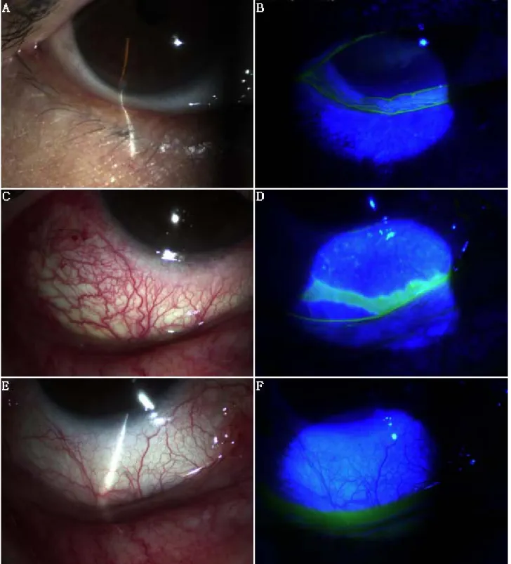 Figure 6. (A, B) Preoperative appearance showed the redundant conjunctival tissue and interruption of lower tear meniscus