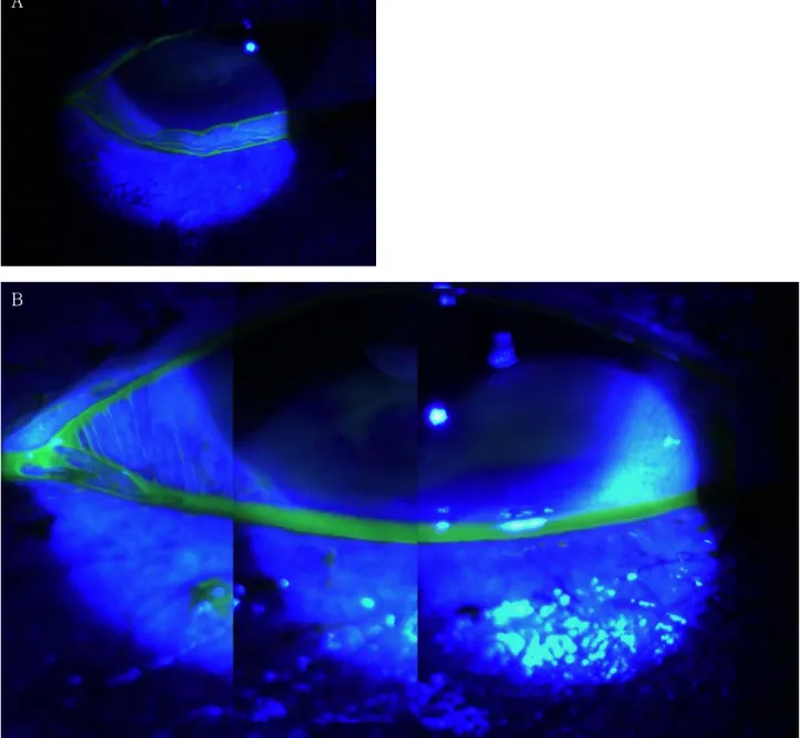 Fig. 7. (A) Preoperative photograph shows interruption of the lower tear meniscus. (B) Three months after operation, panoramic  picture of representative exam ple of a patient w ith conjunctivochalasis