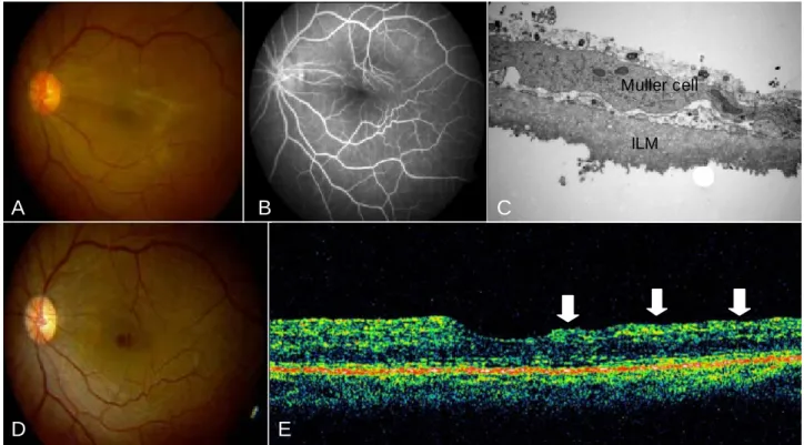 Table 2. Comparison of log MAR(minimum angle of correction) best corrected visual acuity measured preoperatively and  postopertively in each disease