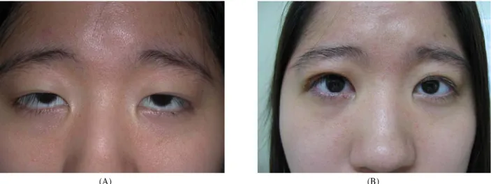 Figure 1. (A) Preoperative view of a 22-year-old female patient with bilateral aponeurotic ptosis with good levator function  measured 12 mm